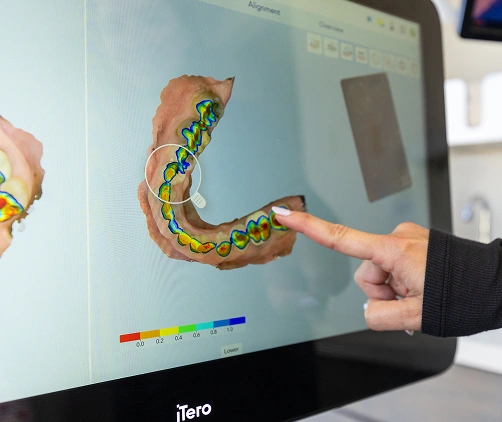 Close-up of iTero digital scanner capturing a precise 3D impression of a patient's teeth at Dr. Andrew Jackson DDS